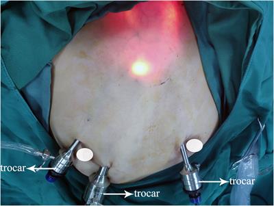 Endoscopic thyroidectomy via areola approach for stage T1 papillary thyroid carcinoma: feasibility, safety, and oncologic outcomes